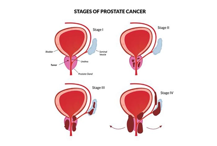 Joe Biden’s Prostate Cancer is a wake-up call: Jewish people are at elevated risk
